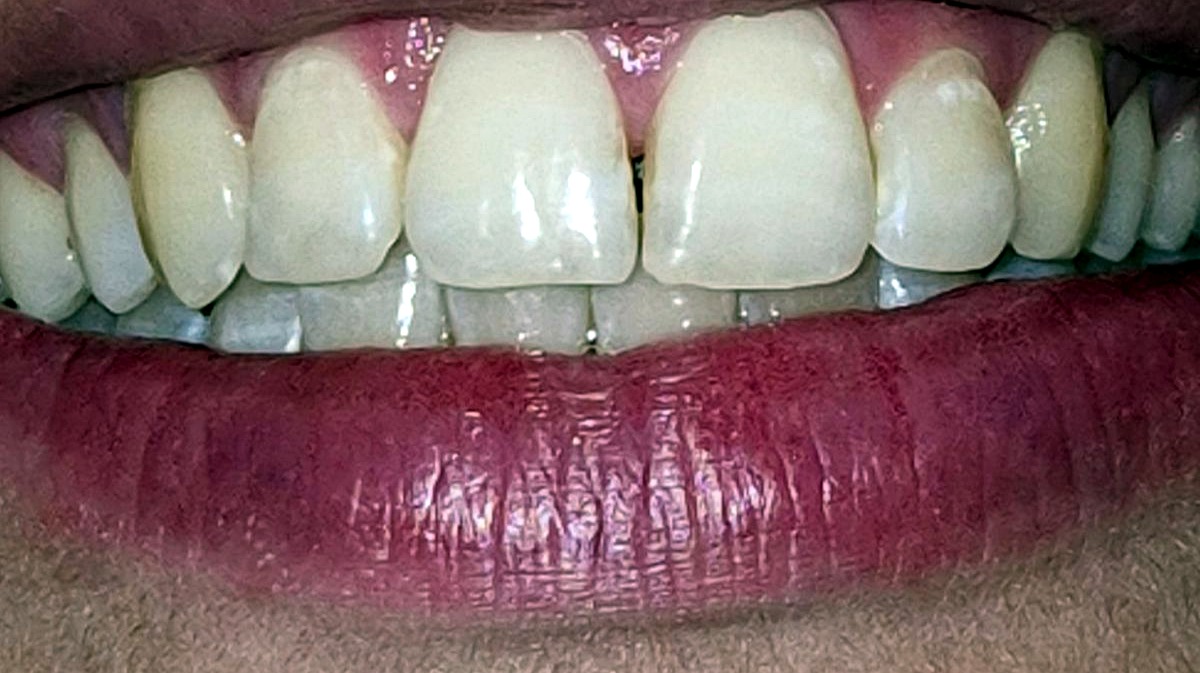 Kosmetische Zahnaufhellung Referenz von SOULAIR Beauty Studio